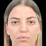 Thumbnail photo of the patient’s before the Rhinoplasty Patient 36