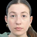 Thumbnail photo of the patient’s before the Rhinoplasty Patient 37