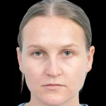 Thumbnail photo of the patient’s before the Rhinoplasty Patient 38