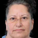 Thumbnail photo of the patient’s before the Rhinoplasty Patient 40