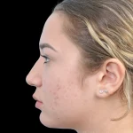 Thumbnail photo of the patient’s before the Rhinoplasty Patient 15