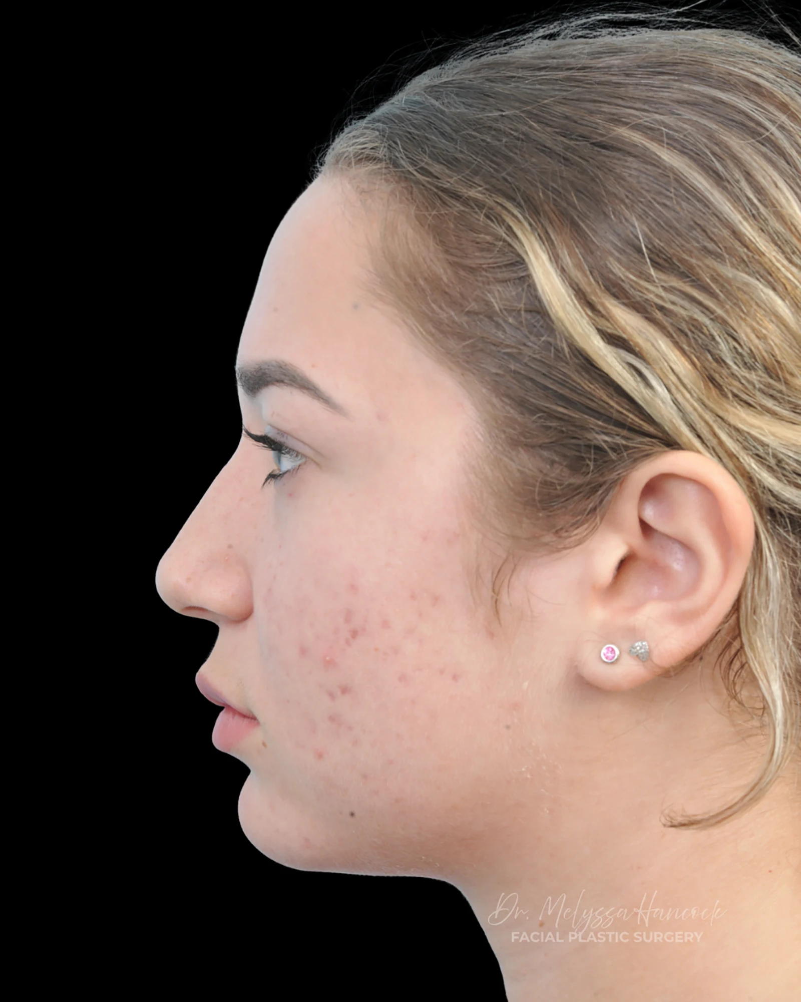 Photo of the patient’s before the Rhinoplasty Patient 15