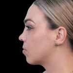 Thumbnail photo of the patient’s before the Rhinoplasty Patient 20