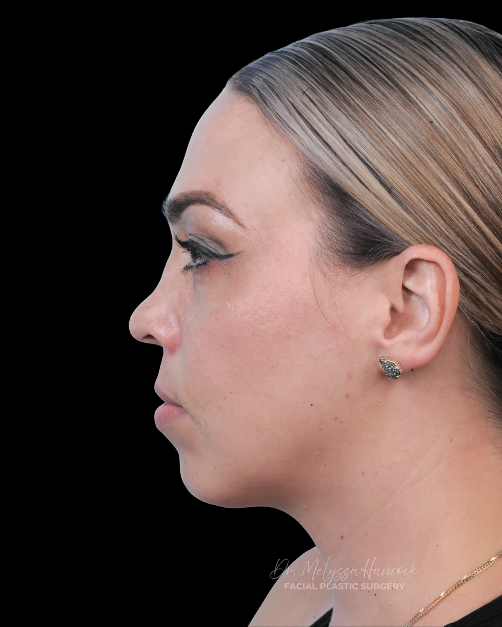 Photo of the patient’s before the Rhinoplasty Patient 20