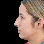 Thumbnail photo of the patient’s before the Rhinoplasty Patient 26