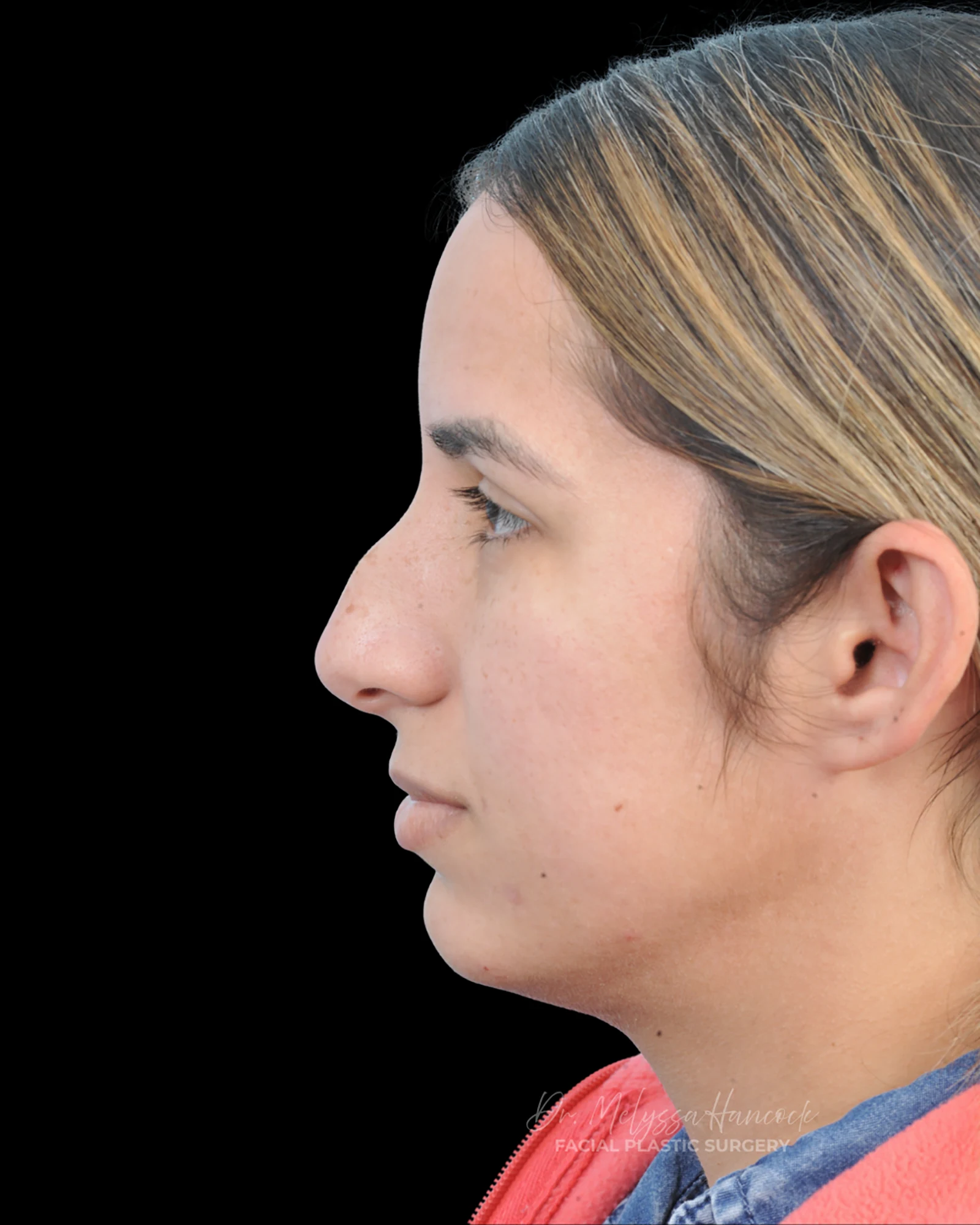Photo of the patient’s before the Rhinoplasty Patient 26