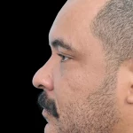 Thumbnail photo of the patient’s before the Rhinoplasty Patient 27