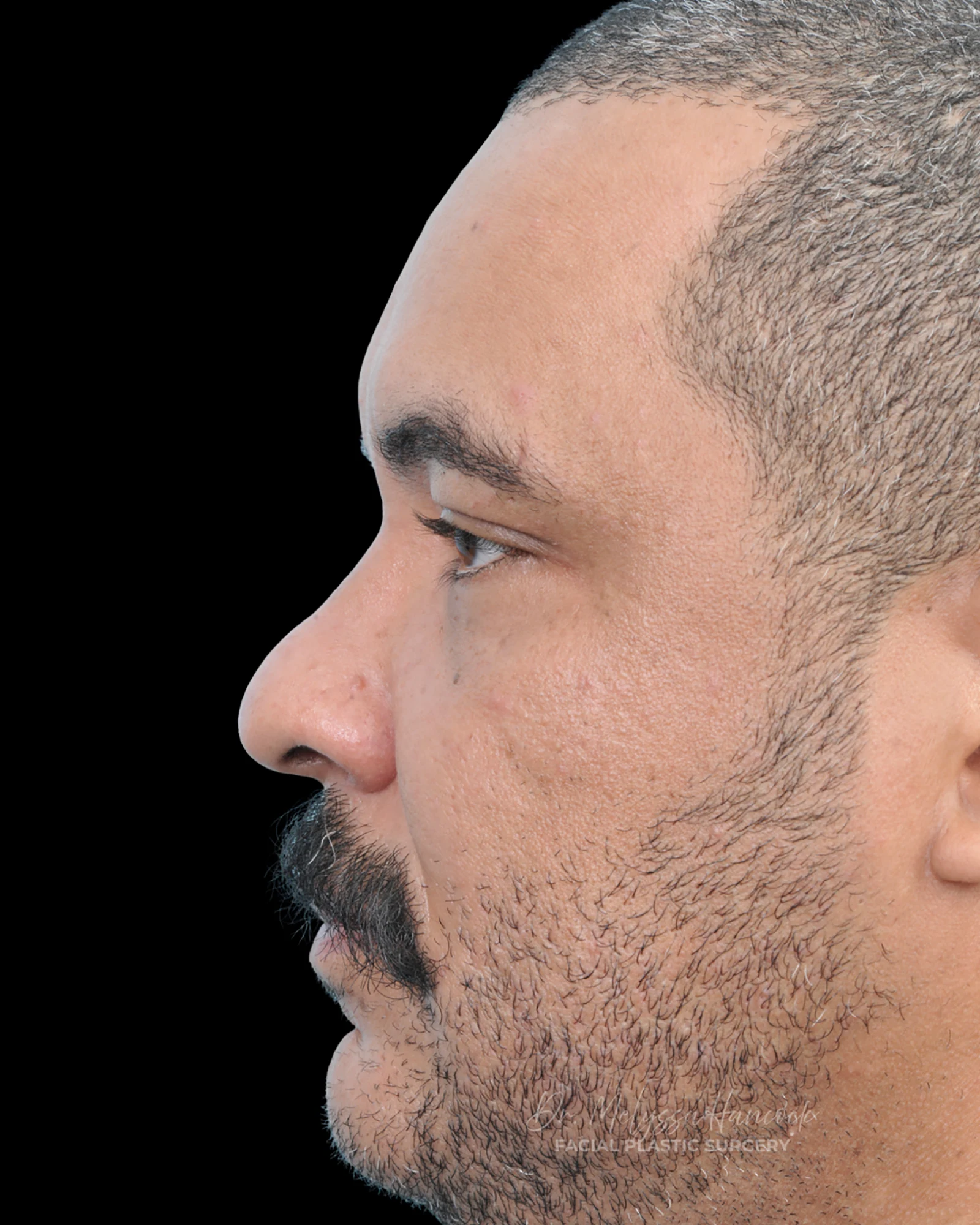Photo of the patient’s before the Rhinoplasty Patient 27