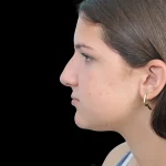 Thumbnail photo of the patient’s before the Rhinoplasty Patient 28