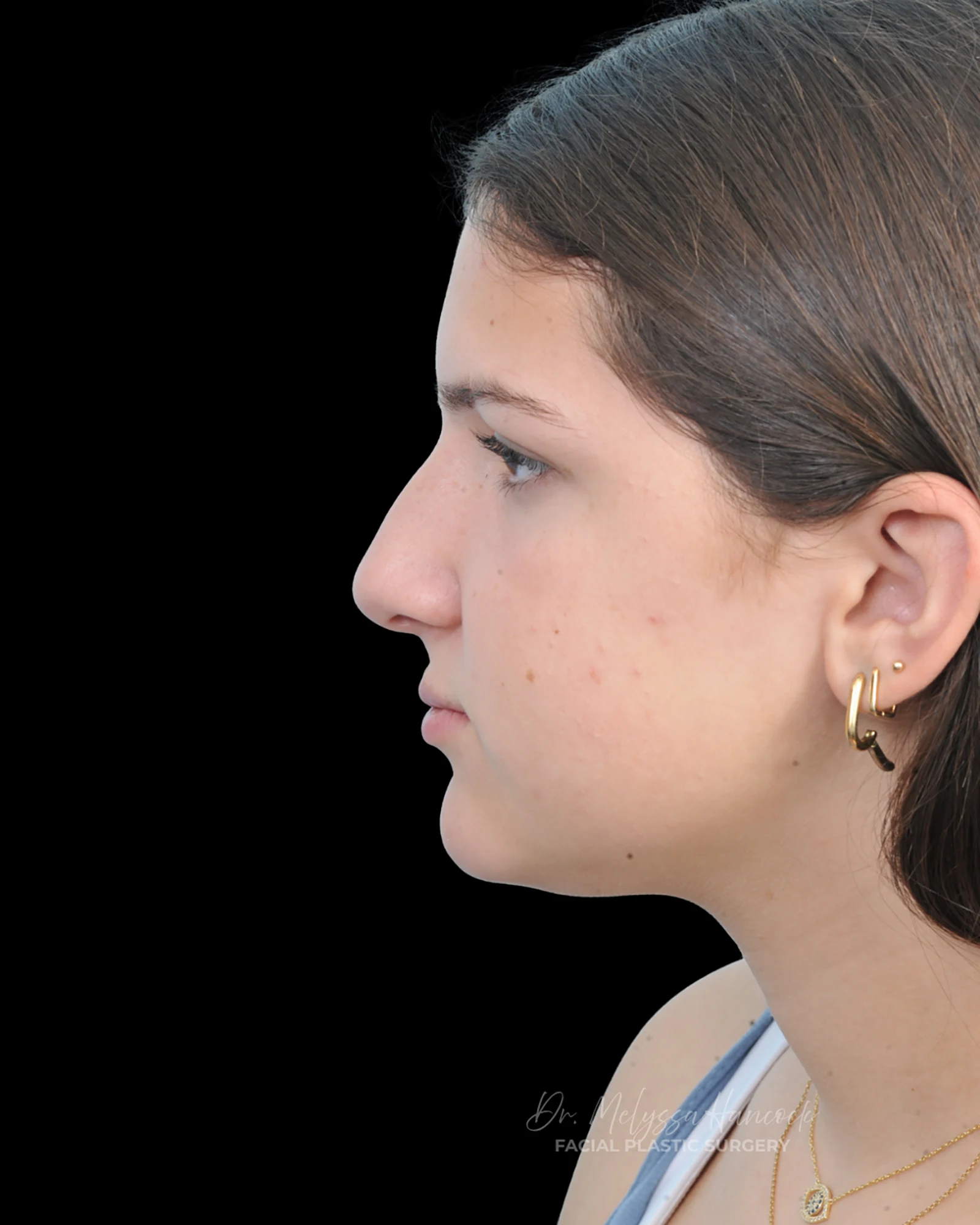 Photo of the patient’s before the Rhinoplasty Patient 28