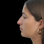 Thumbnail photo of the patient’s before the Rhinoplasty Patient 29