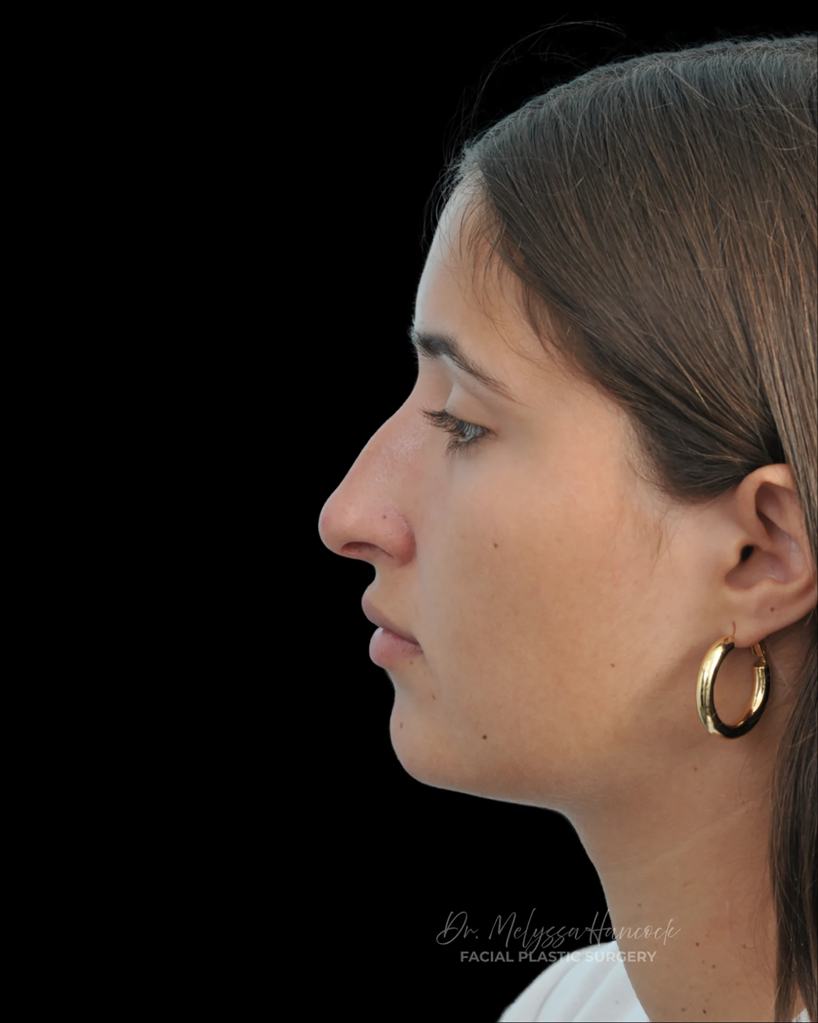 Photo of the patient’s before the Rhinoplasty Patient 29