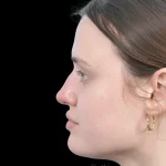 Thumbnail photo of the patient’s before the Rhinoplasty Patient 30