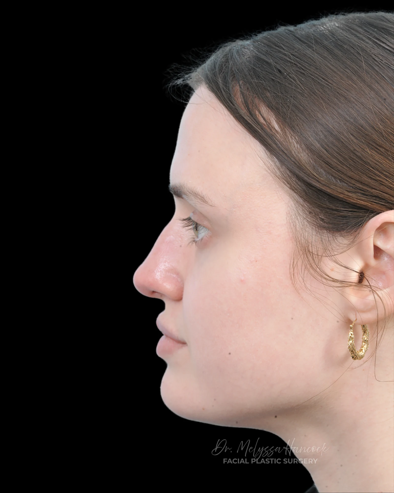 Photo of the patient’s before the Rhinoplasty Patient 30
