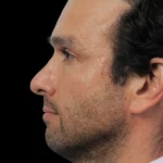 Thumbnail photo of the patient’s before the Rhinoplasty Patient 31