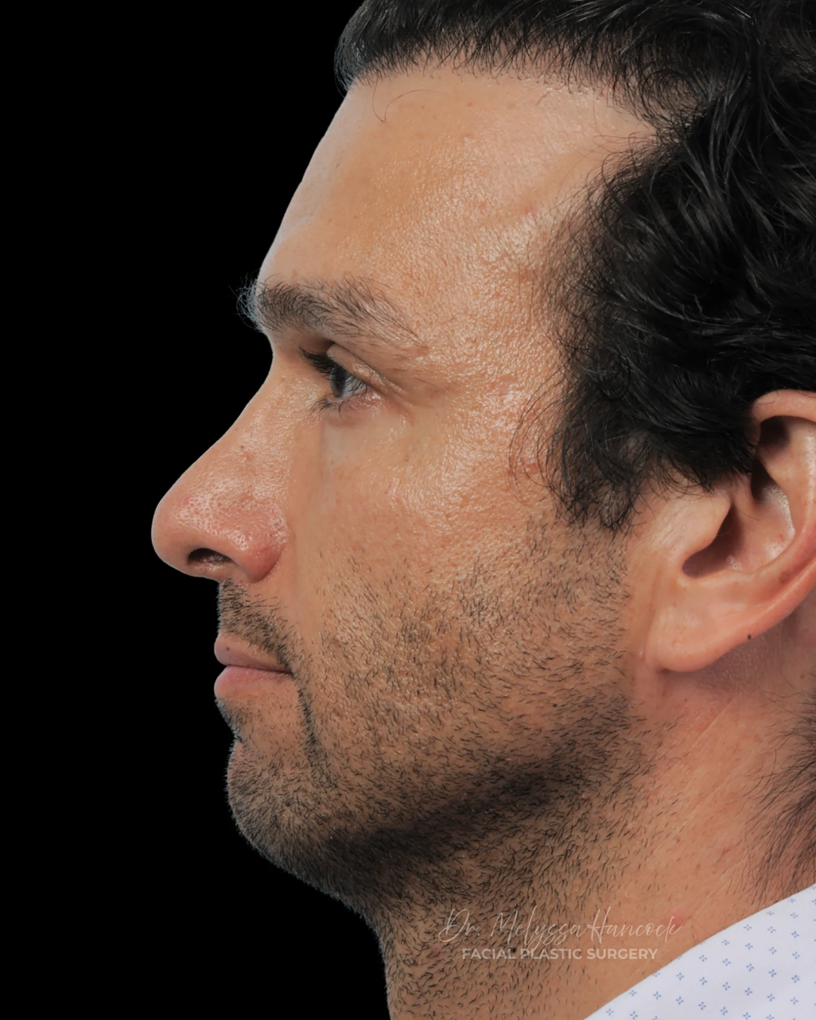 Photo of the patient’s before the Rhinoplasty Patient 31