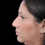Thumbnail photo of the patient’s before the Rhinoplasty Patient 32