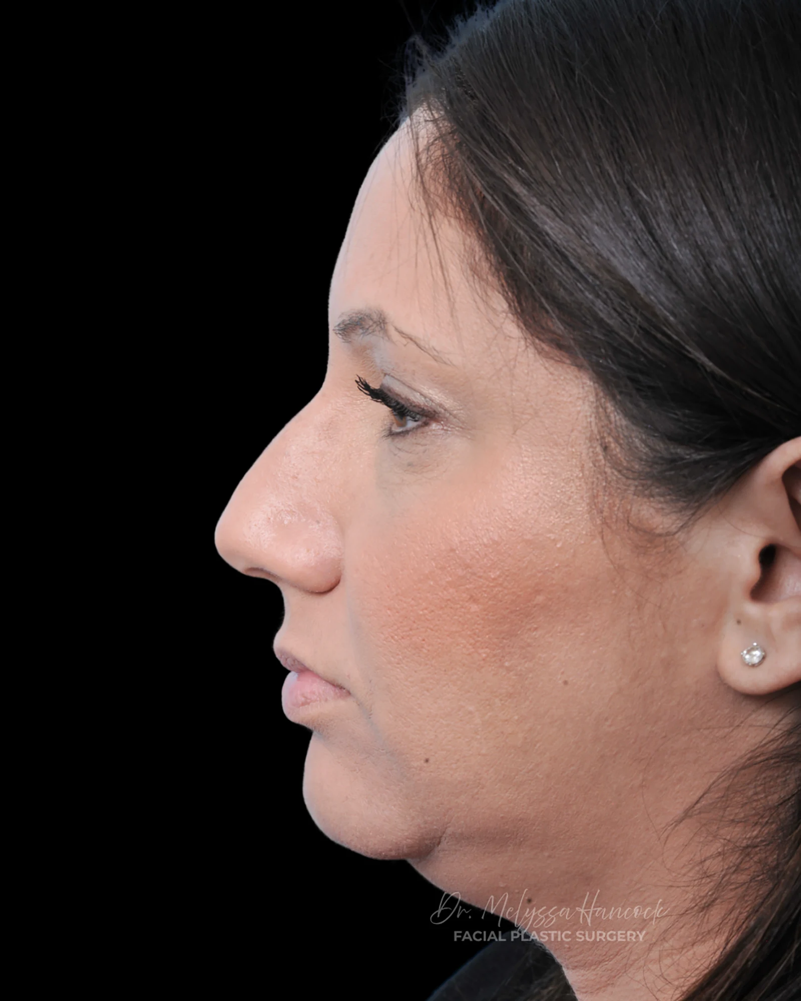 Photo of the patient’s before the Rhinoplasty Patient 32
