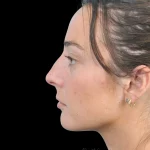 Thumbnail photo of the patient’s before the Rhinoplasty Patient 33
