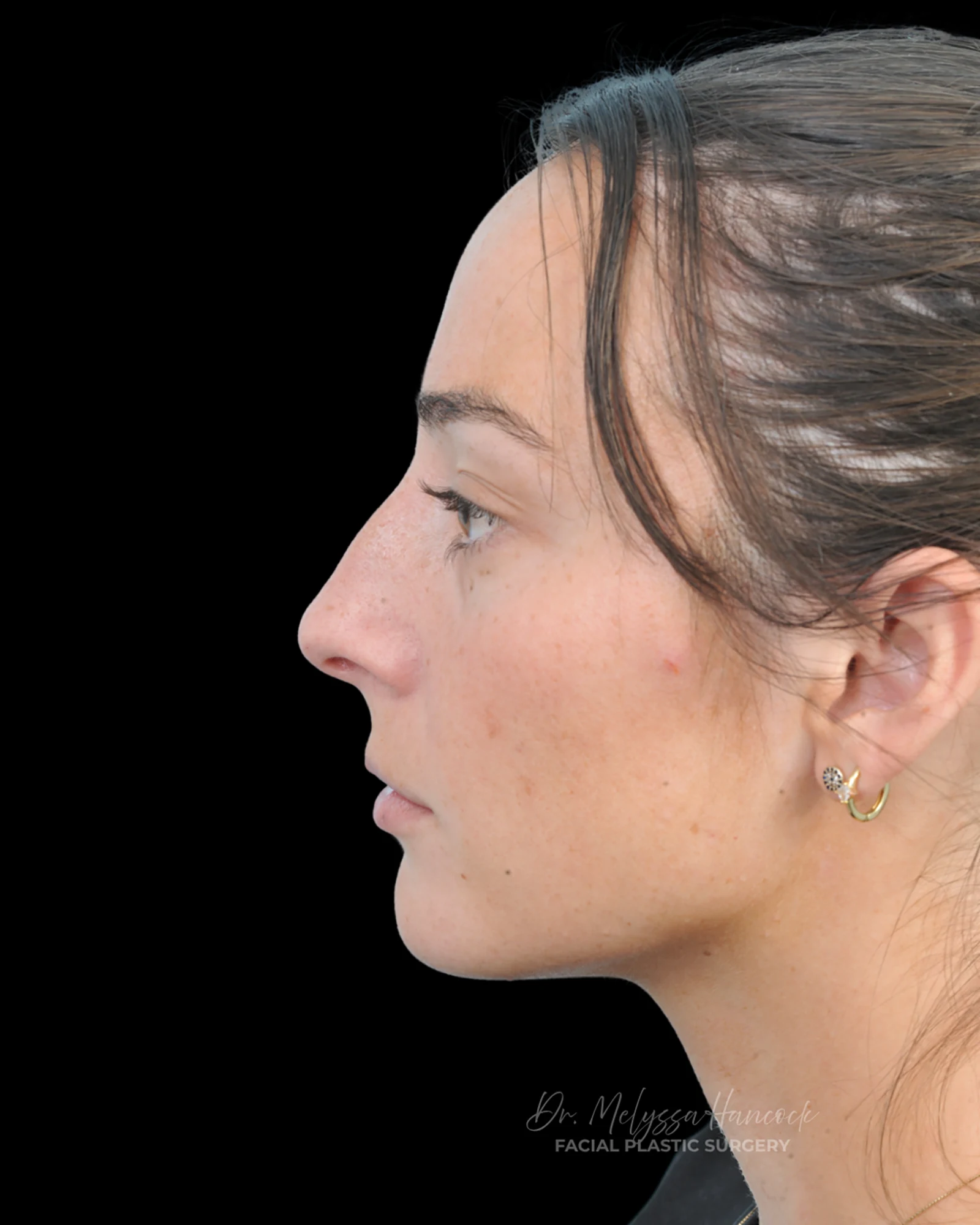 Photo of the patient’s before the Rhinoplasty Patient 33