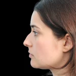 Thumbnail photo of the patient’s before the Rhinoplasty Patient 34