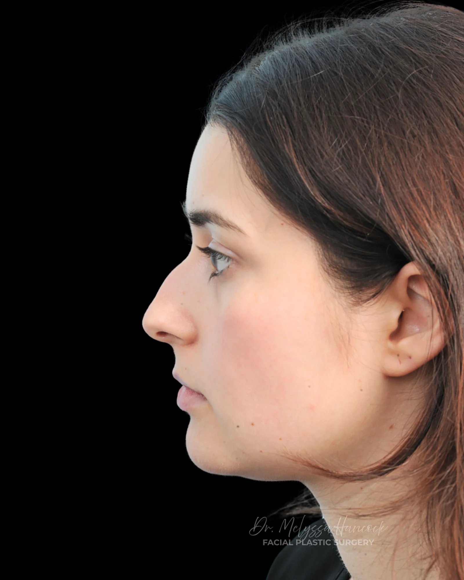 Photo of the patient’s before the Rhinoplasty Patient 34