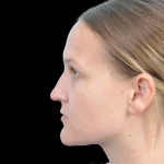 Thumbnail photo of the patient’s before the Rhinoplasty Patient 38
