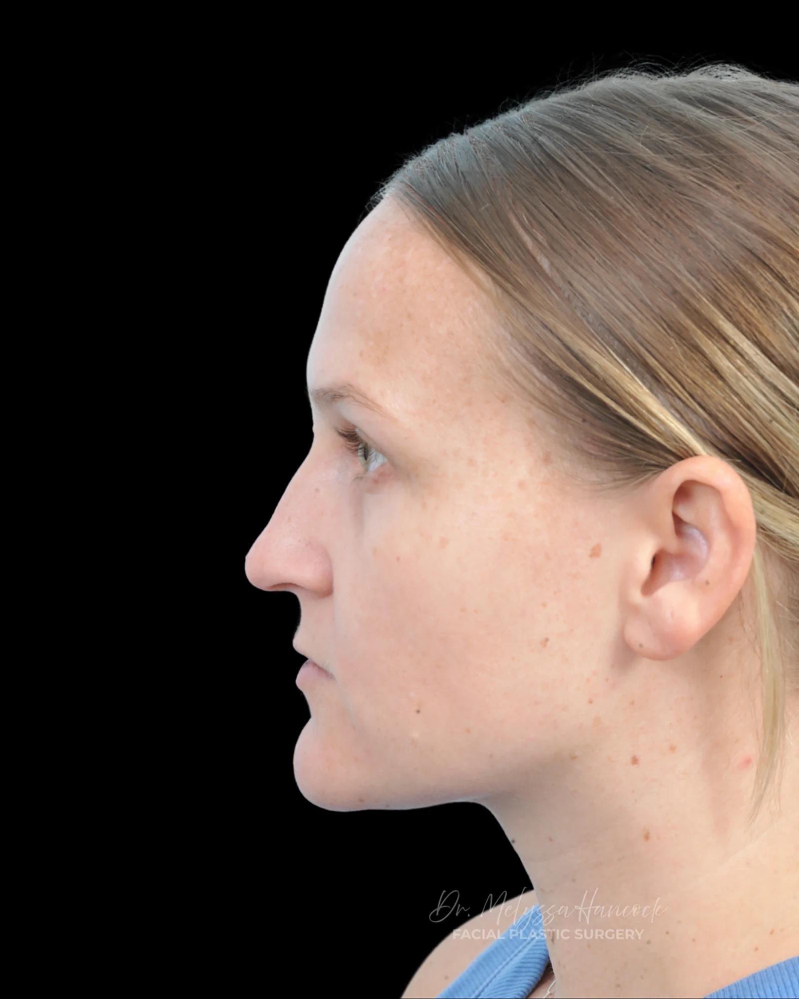 Photo of the patient’s before the Rhinoplasty Patient 38