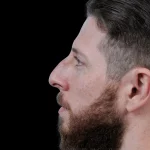 Thumbnail photo of the patient’s before the Rhinoplasty Patient 39