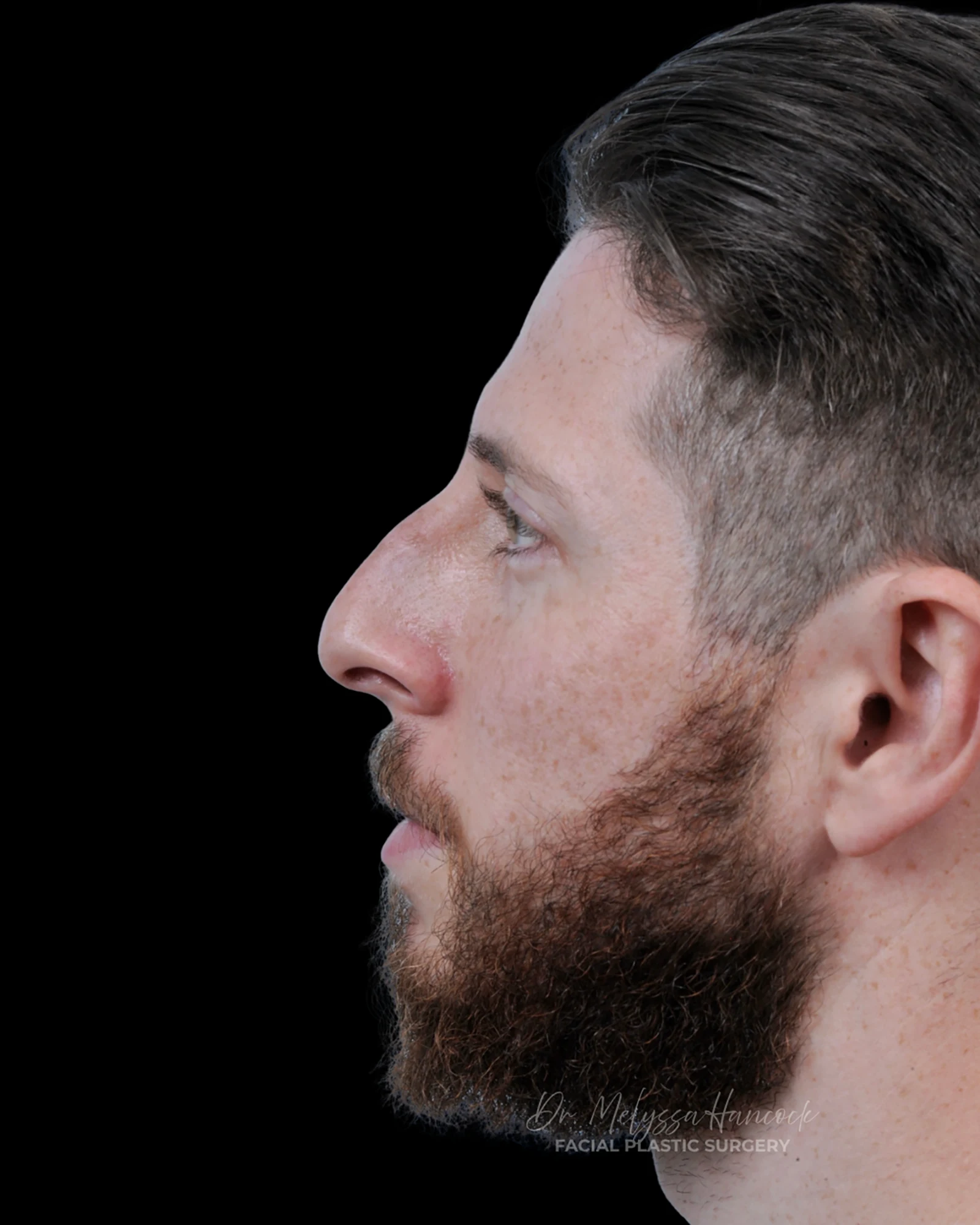 Photo of the patient’s before the Rhinoplasty Patient 39
