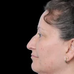 Thumbnail photo of the patient’s before the Rhinoplasty Patient 40