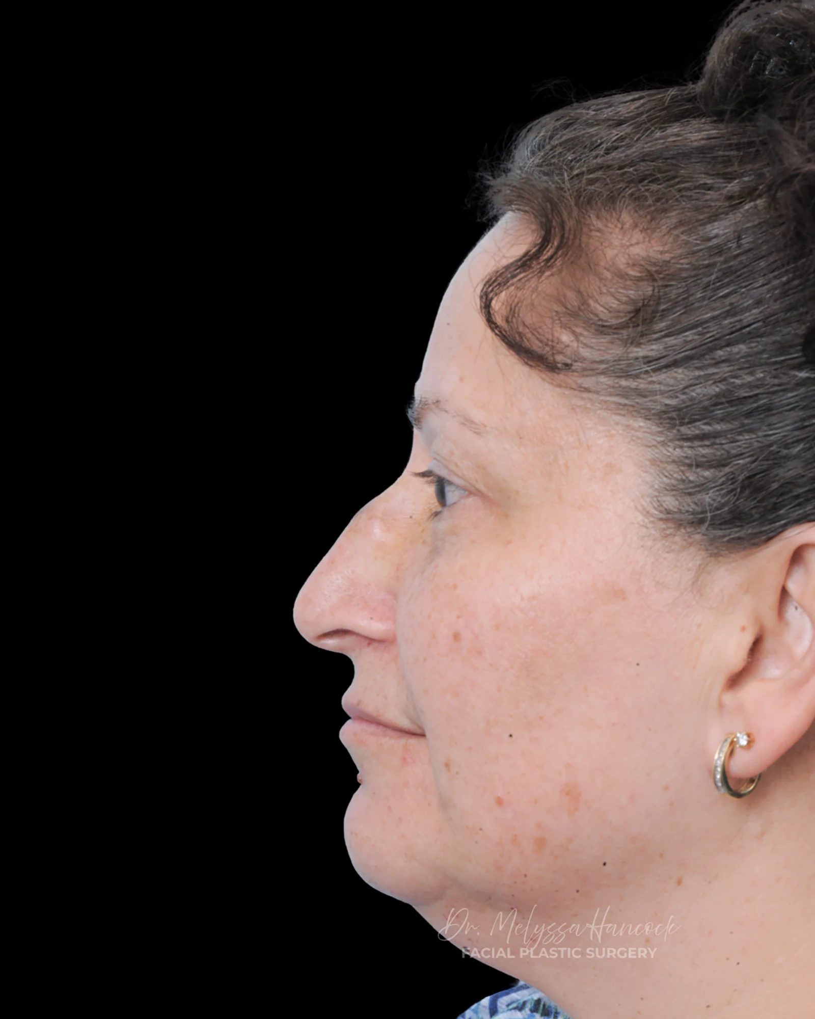 Photo of the patient’s before the Rhinoplasty Patient 40