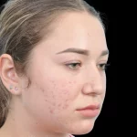 Thumbnail photo of the patient’s before the Rhinoplasty Patient 15