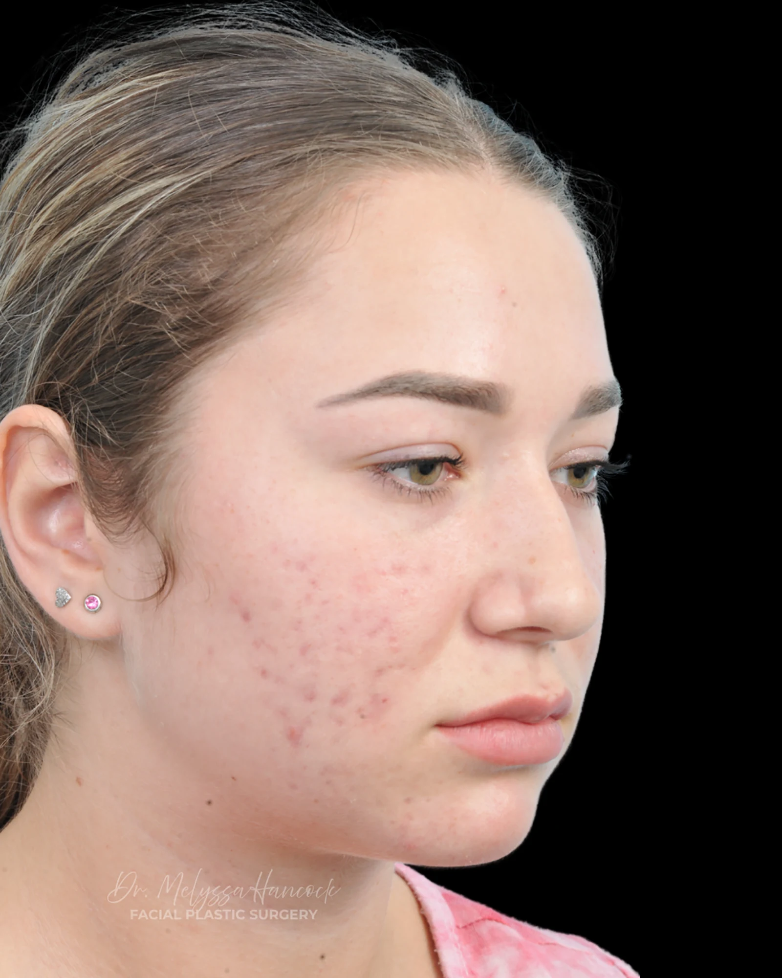 Photo of the patient’s before the Rhinoplasty Patient 15