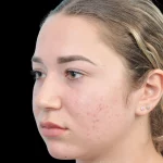 Thumbnail photo of the patient’s before the Rhinoplasty Patient 15
