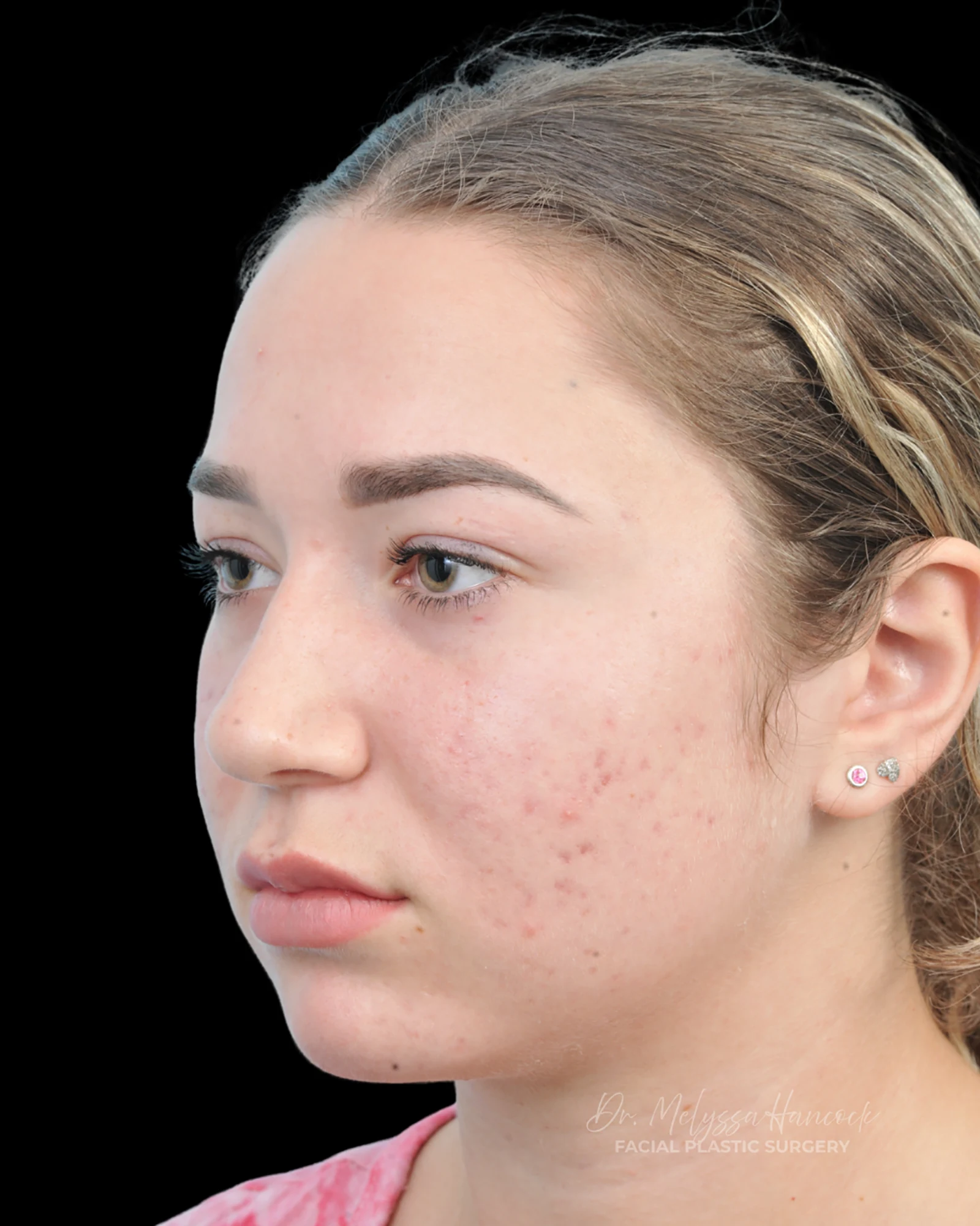 Photo of the patient’s before the Rhinoplasty Patient 15