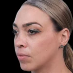 Thumbnail photo of the patient’s before the Rhinoplasty Patient 20