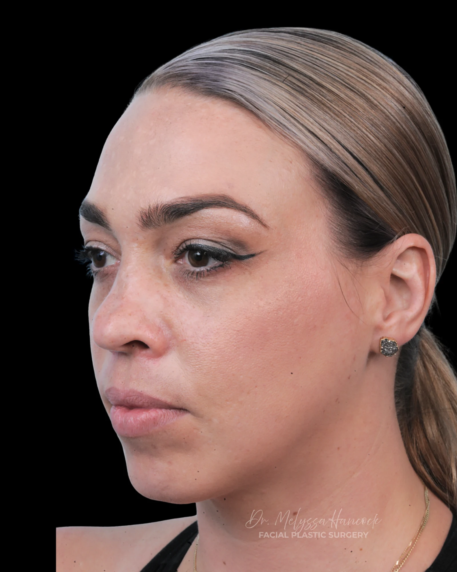 Photo of the patient’s before the Rhinoplasty Patient 20