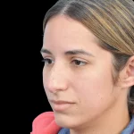 Thumbnail photo of the patient’s before the Rhinoplasty Patient 26