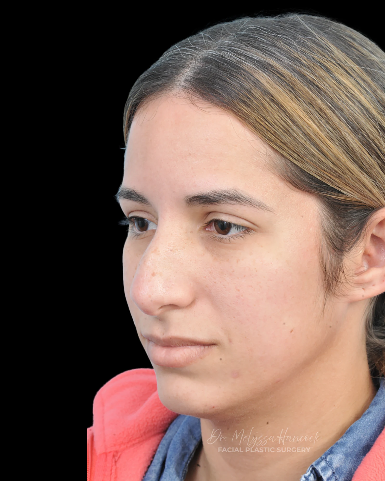 Photo of the patient’s before the Rhinoplasty Patient 26
