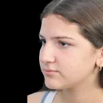 Thumbnail photo of the patient’s before the Rhinoplasty Patient 28