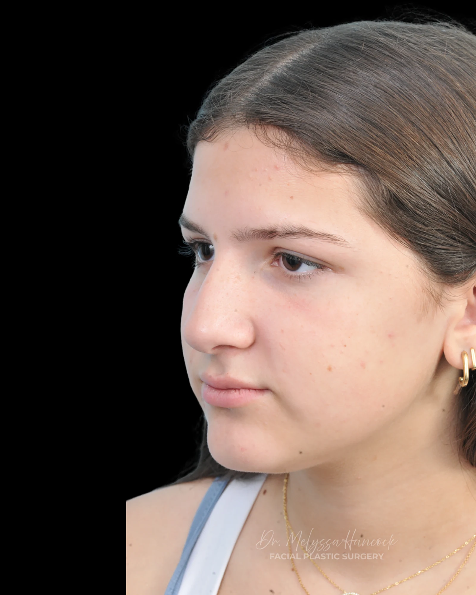 Photo of the patient’s before the Rhinoplasty Patient 28