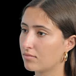 Thumbnail photo of the patient’s before the Rhinoplasty Patient 29