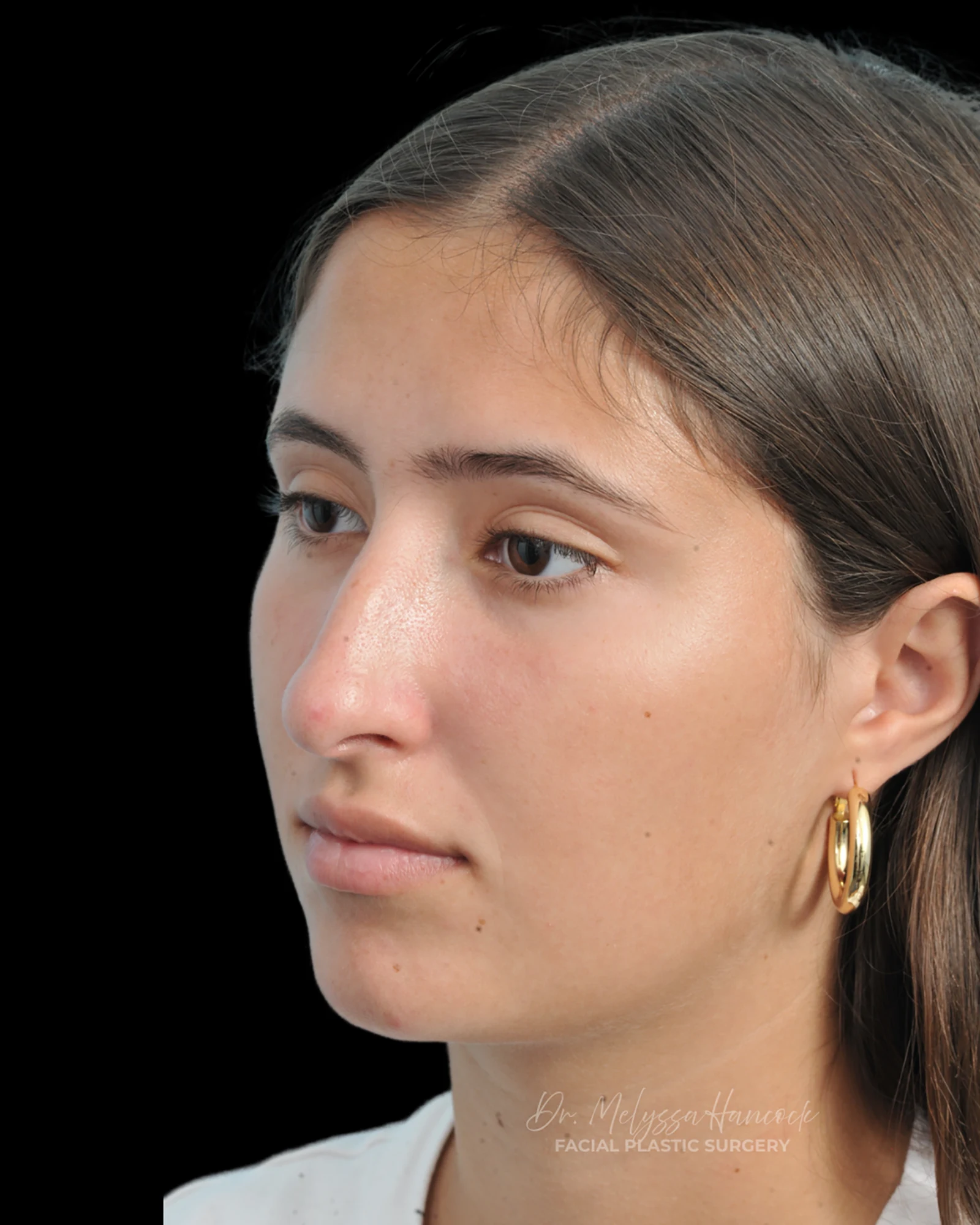 Photo of the patient’s before the Rhinoplasty Patient 29