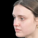 Thumbnail photo of the patient’s before the Rhinoplasty Patient 30