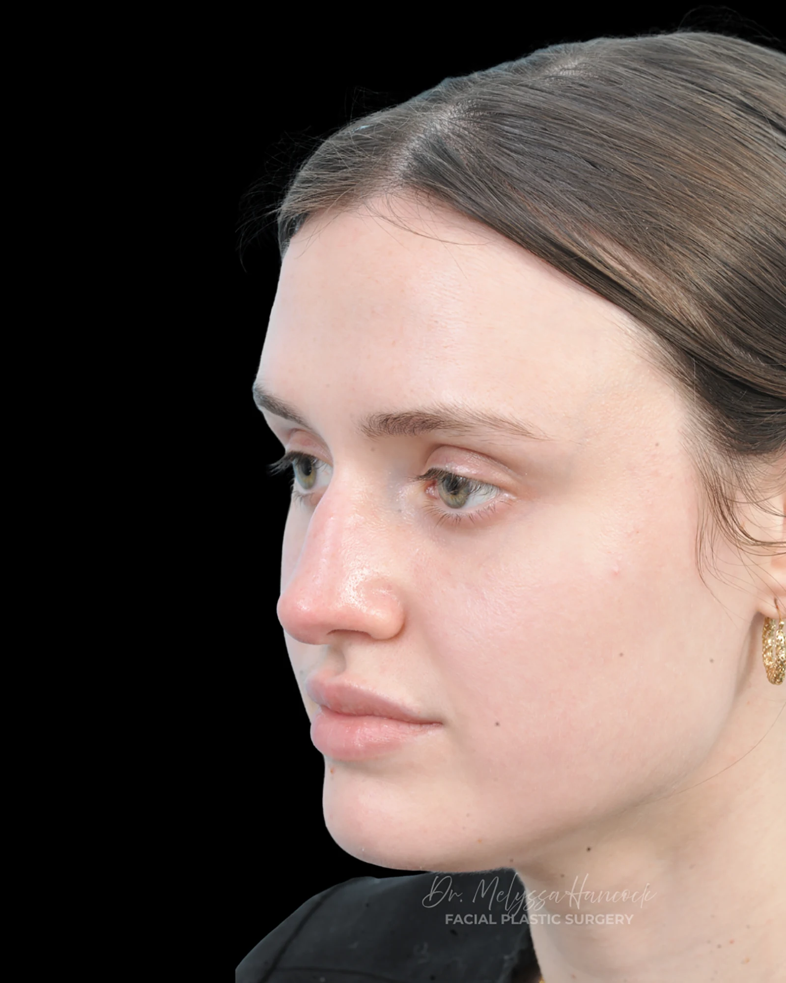 Photo of the patient’s before the Rhinoplasty Patient 30