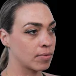 Thumbnail photo of the patient’s before the Rhinoplasty Patient 20