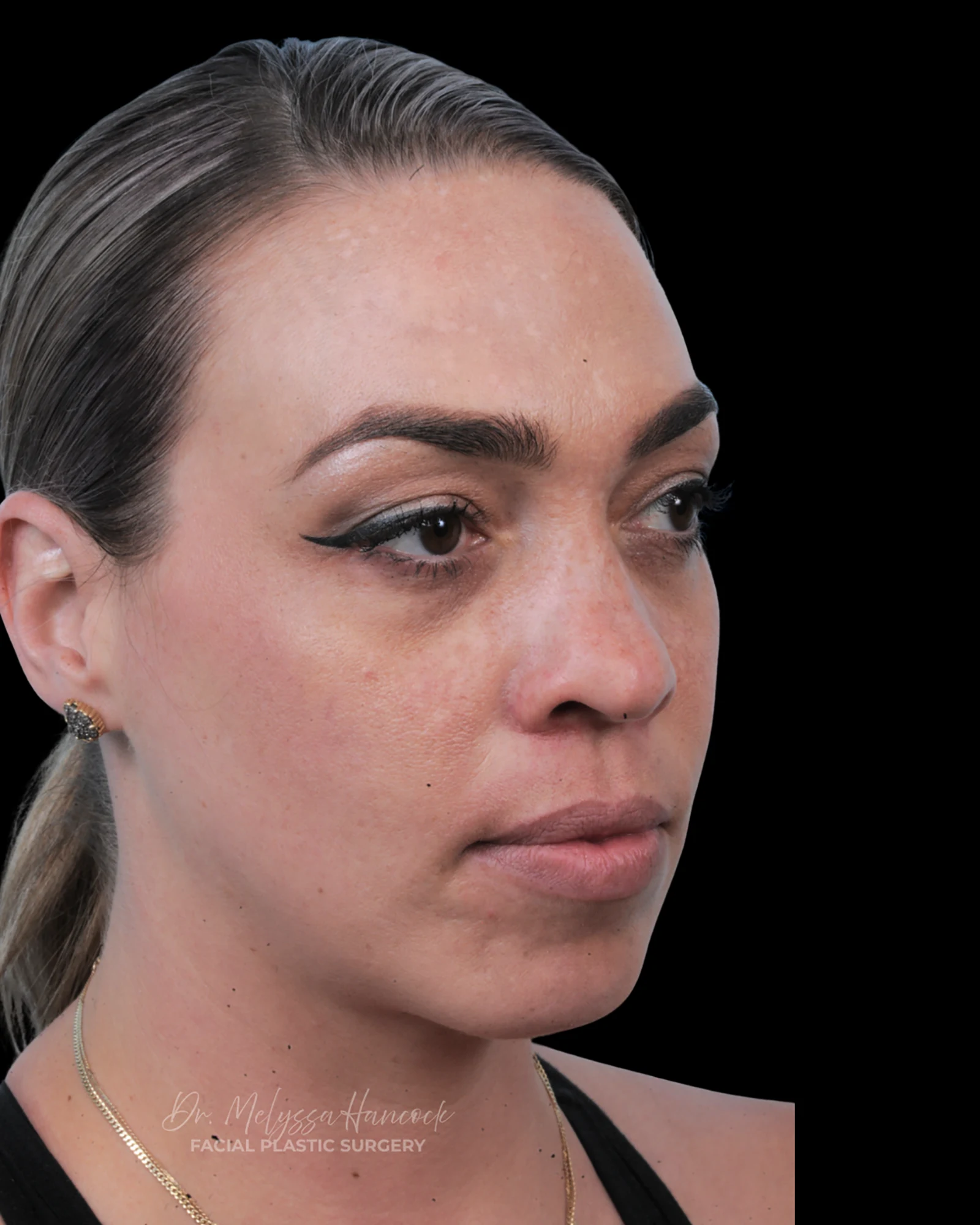 Photo of the patient’s before the Rhinoplasty Patient 20