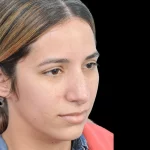 Thumbnail photo of the patient’s before the Rhinoplasty Patient 26