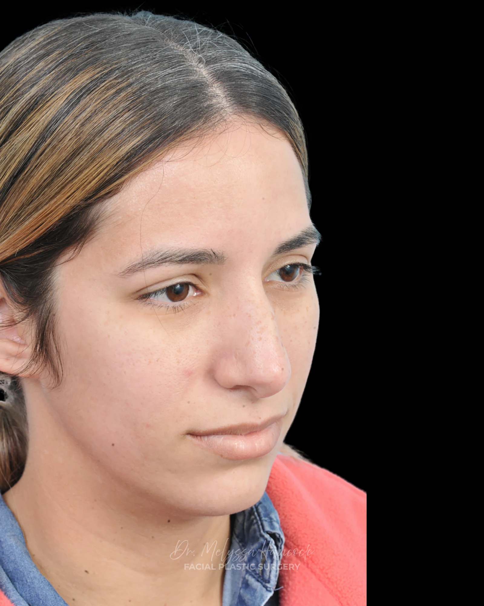 Photo of the patient’s before the Rhinoplasty Patient 26